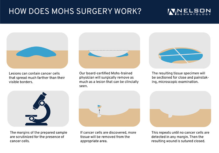 Discover the steps involved in Mohs surgery at St. Petersburg and South Pasadena's Nelson Dermatology.