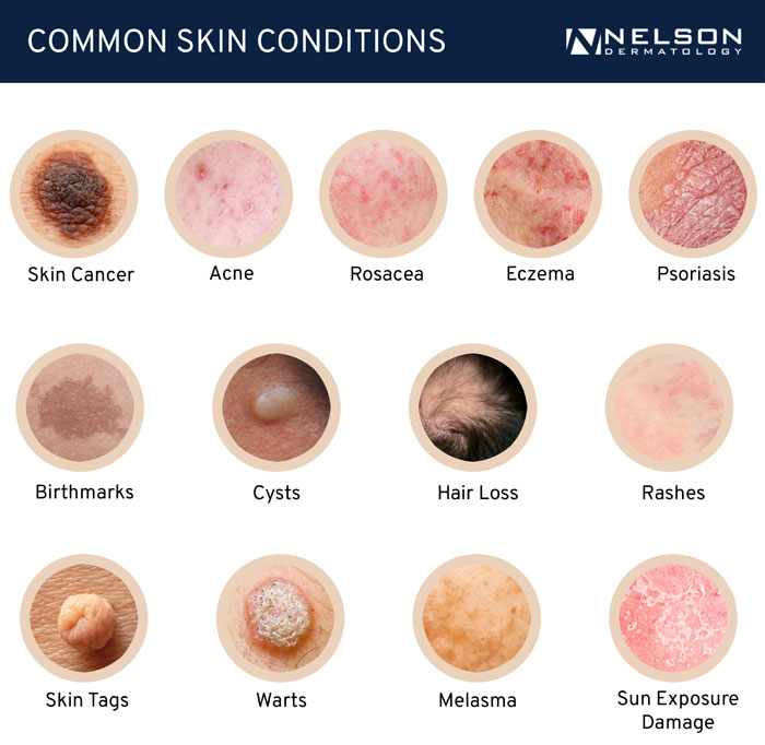 Medical dermatology at St. Petersburg and St. Pete Beach’s Nelson Dermatology diagnoses and treats a range of skin, hair, and nail conditions.